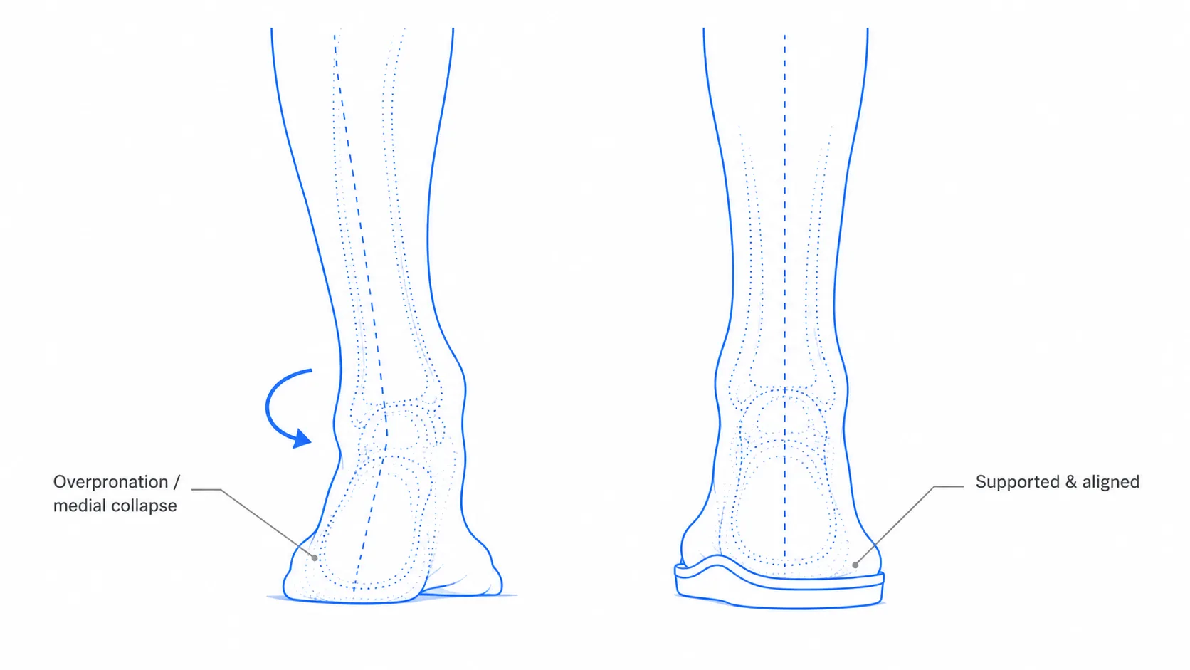 Diagram of an overpronating flat foot rolling inward versus the same foot supported and aligned by a custom insole