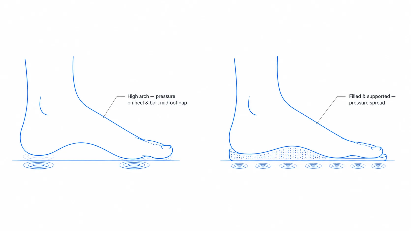Diagram of a high-arched foot with pressure concentrated on heel and ball and the midfoot lifted, versus the same foot with an insole filling the arch and spreading pressure