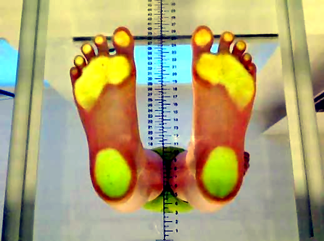 Real podoscope glass exam showing both feet and contact pressure areas